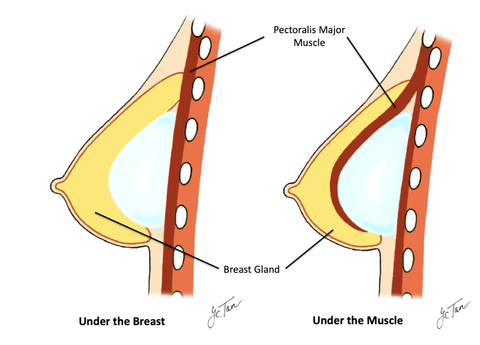 Breast Augmentation